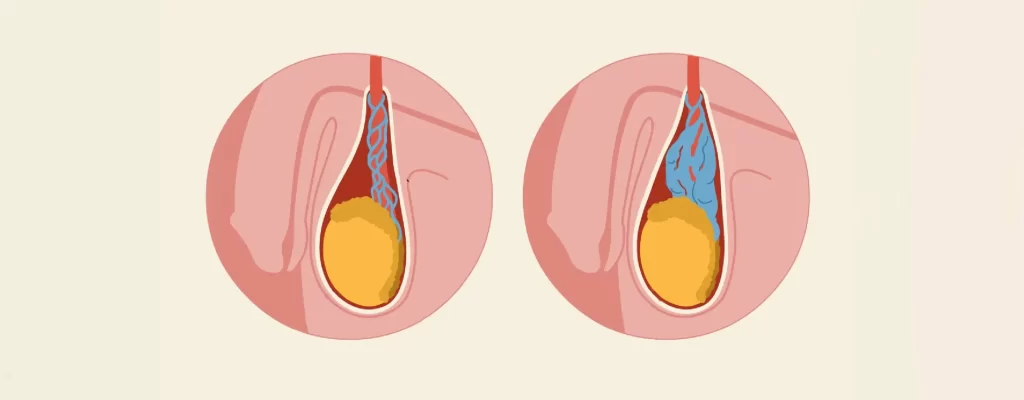 مزایای جراحی میکروسکوپیک واریکوسل