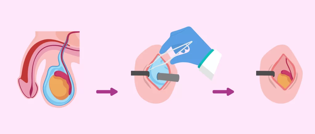 جراحی بیضه برای درمان هیدروسل
