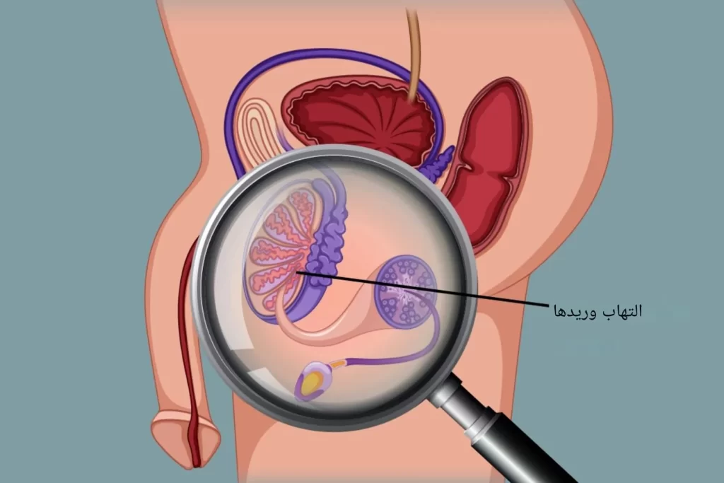 عوارض جراحی میکروسکوپی واریکوسل