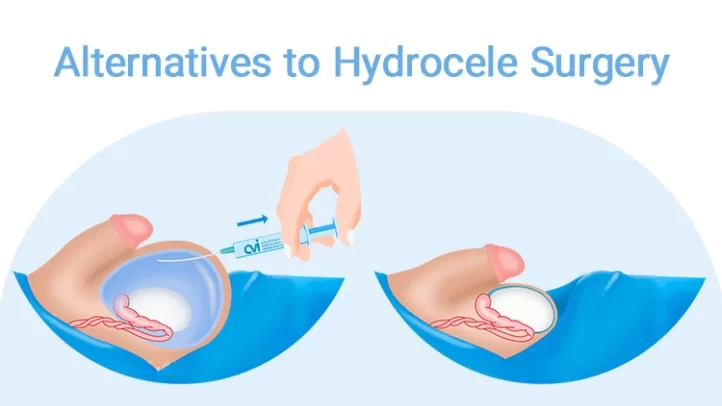 هزینه جراحی هیدروسل چقدر است؟