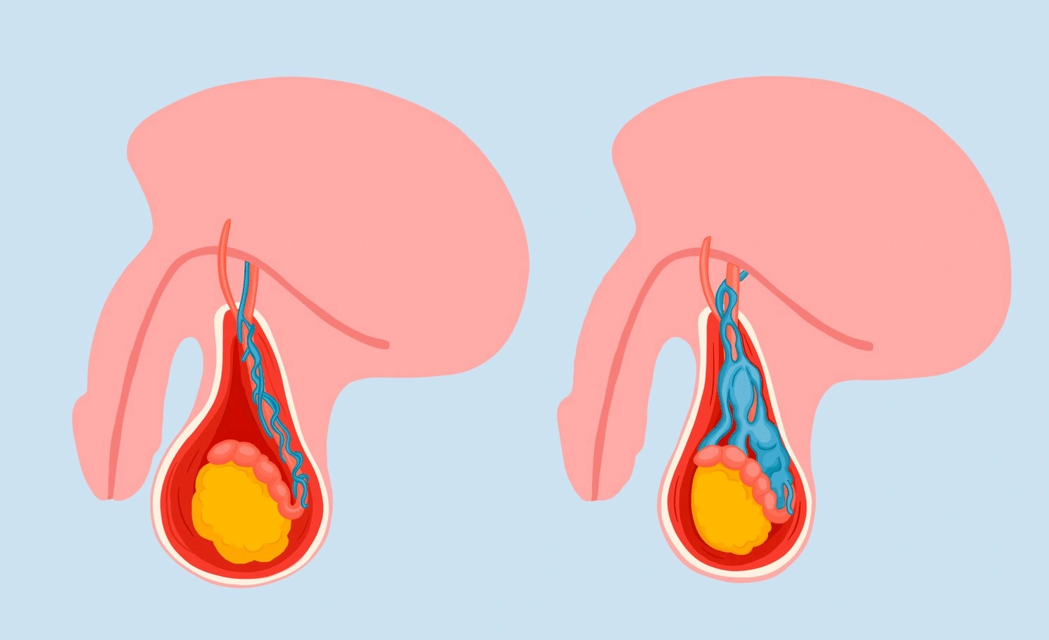 علل هیدروسل
