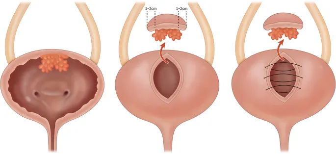 جراحی تومور مثانه