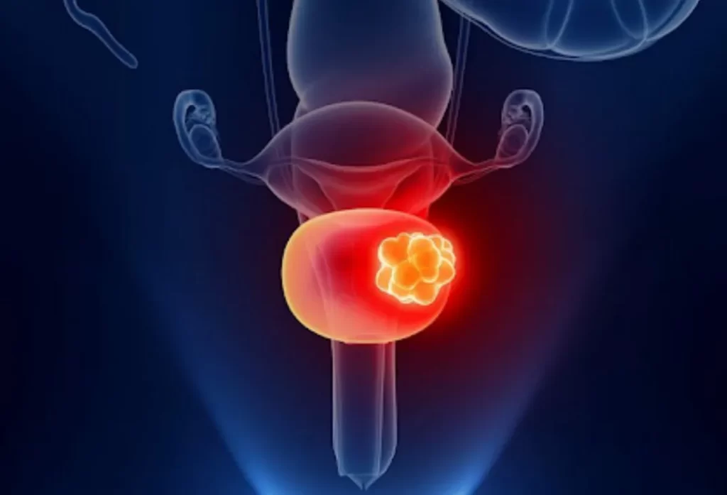 جراحی تومور مثانه