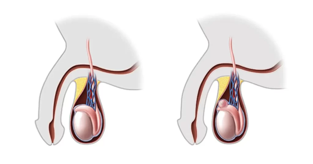 کیست بیضه یا اسپرماتوسل